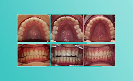Retainers After Braces or Aligners