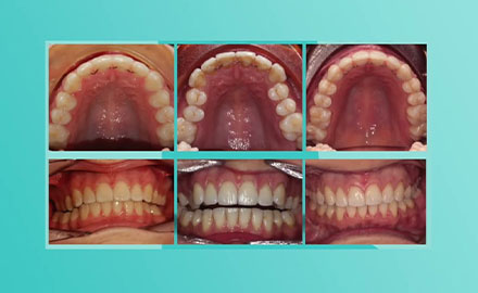 Retainers After Braces or Aligners