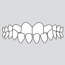 Crossbite (back teeth)