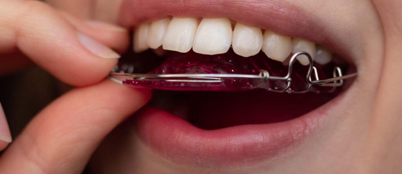 All You Need To Know About Retainers All You Need To Know About Retainers