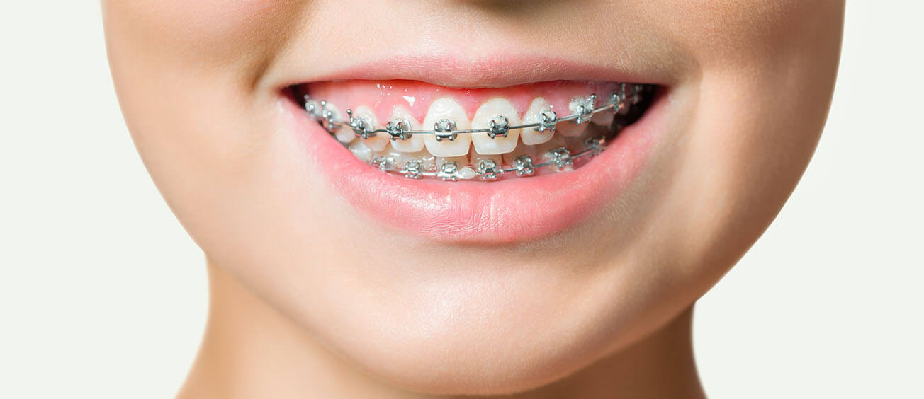 Braces: Cost, Process, Appointments, and Treatment Length Explained Braces: Cost, Process, Appointments, and Treatment Length Explained